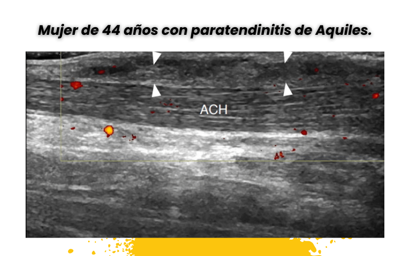 1. Tendon aquiles ecografia tempo formacion.png